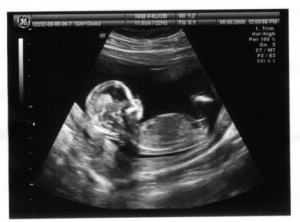 беременность 13 недель