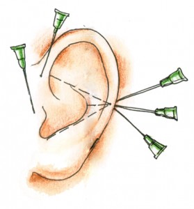 Отопластика является  распространенной операцией по коррекцию ушных раковин.